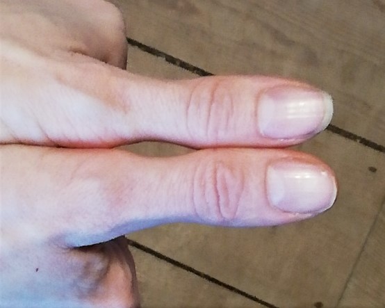 Thumbs Thumbs used to measure fats portion size